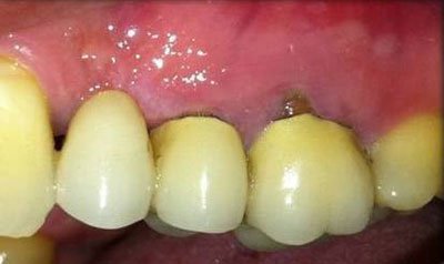 Dental Implant Cases case 12 — before