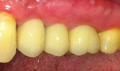 Dental Implant Cases case 12 — after