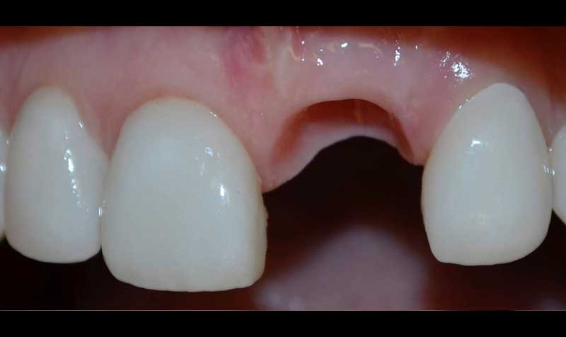 Dental Implant Cases case 131 — before