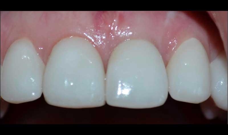 Dental Implant Cases case 131 — after