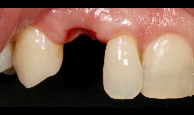 Dental Implant Cases case 132 — before