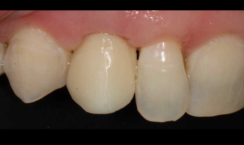 Dental Implant Cases case 132 — after