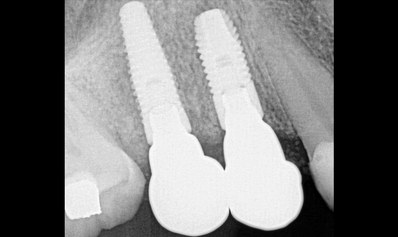 Dental Implant Cases case 133 — before