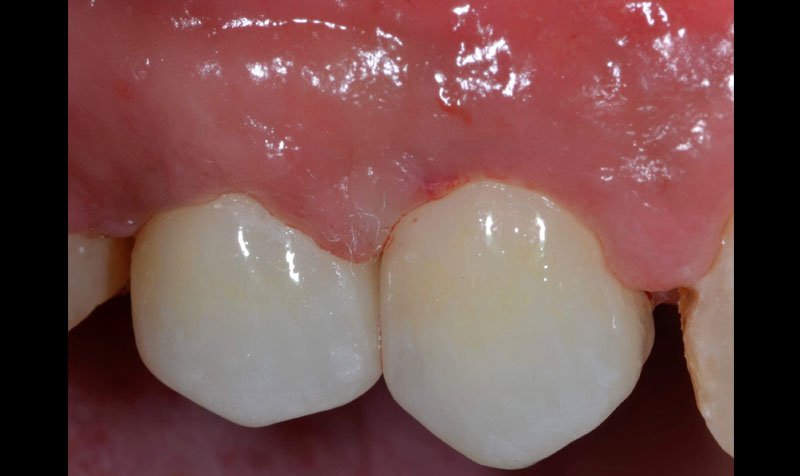 Dental Implant Cases case 133 — after