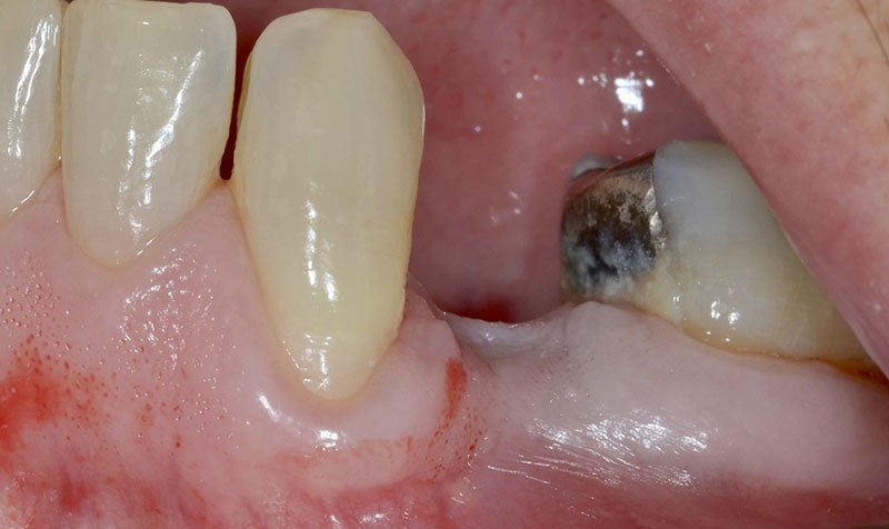 Dental Implant Cases case 142 — before