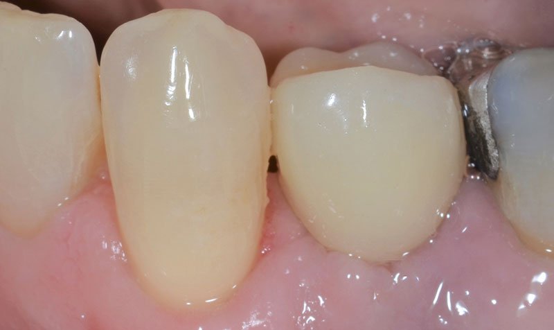 Dental Implant Cases case 142 — after