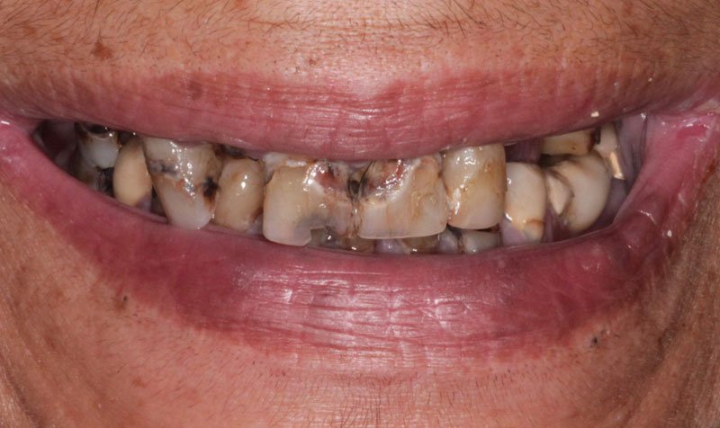 Dental Implant Cases case 145 — before