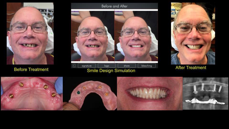 Dental Implant Cases case 156 — before