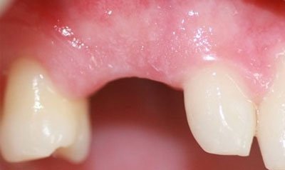 Dental Implant Cases case 16 — before