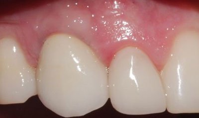 Dental Implant Cases case 16 — after