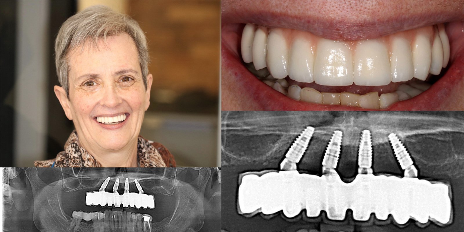 Dental Implant Cases case 160 — before