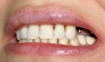 Dental Implant Cases case 17 — before