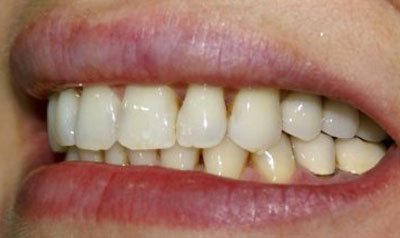 Dental Implant Cases case 17 — after