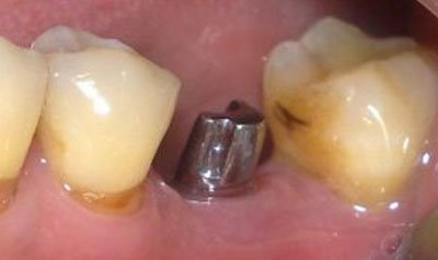 Dental Implant Cases case 18 — before