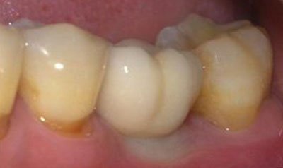 Dental Implant Cases case 18 — after