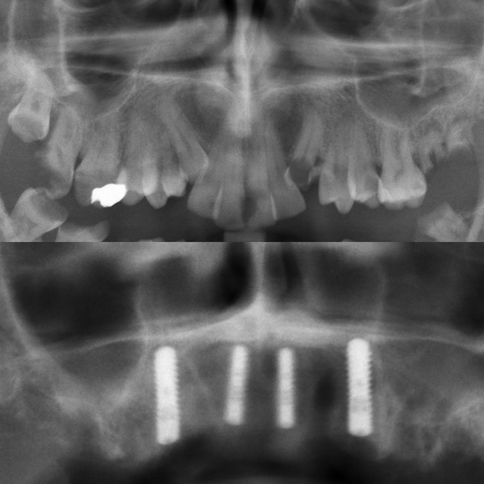 Dental Implant Cases case 186 — before
