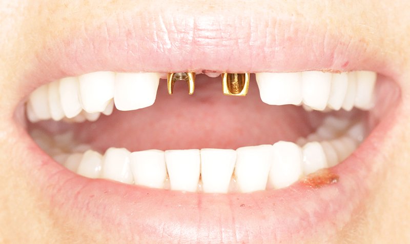 Dental Implant Cases case 189 — before