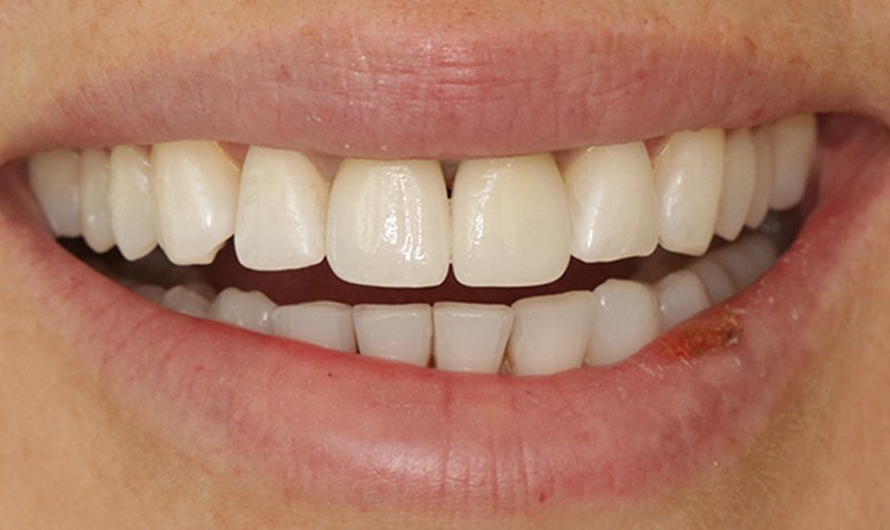 Dental Implant Cases case 189 — after