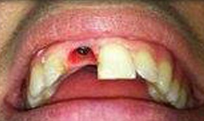 Dental Implant Cases case 19 — before