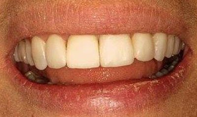 Dental Implant Cases case 19 — after