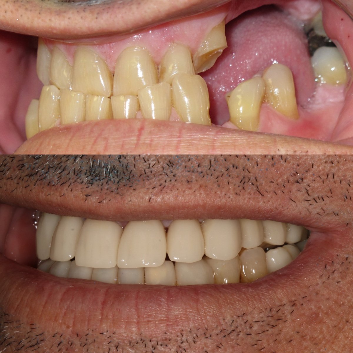 Dental Implant Cases case 199 — before