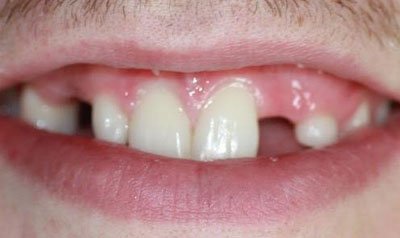 Dental Implant Cases case 20 — before