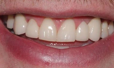 Dental Implant Cases case 20 — after