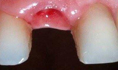 Dental Implant Cases case 22 — before