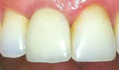 Dental Implant Cases case 22 — after