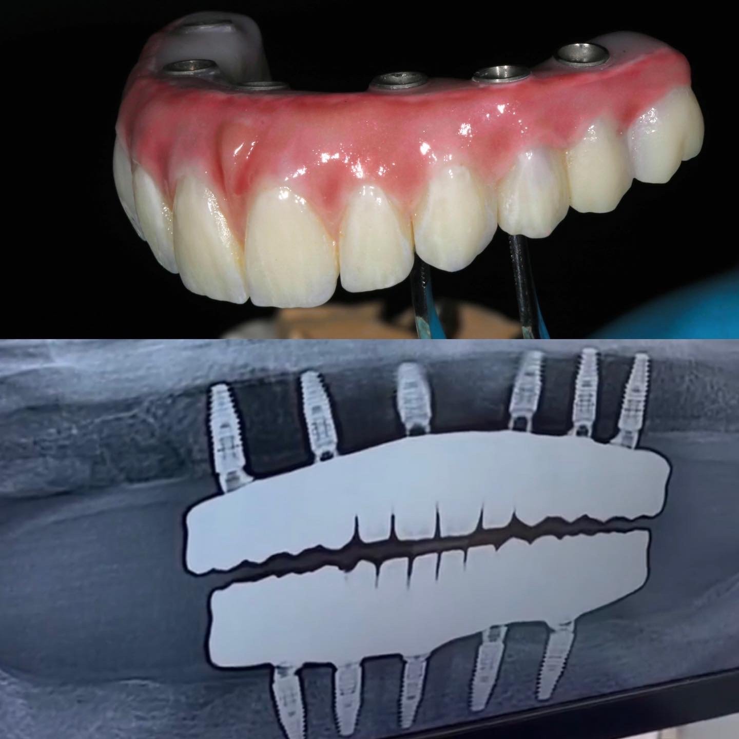 Dental Implant Cases case 220 — before