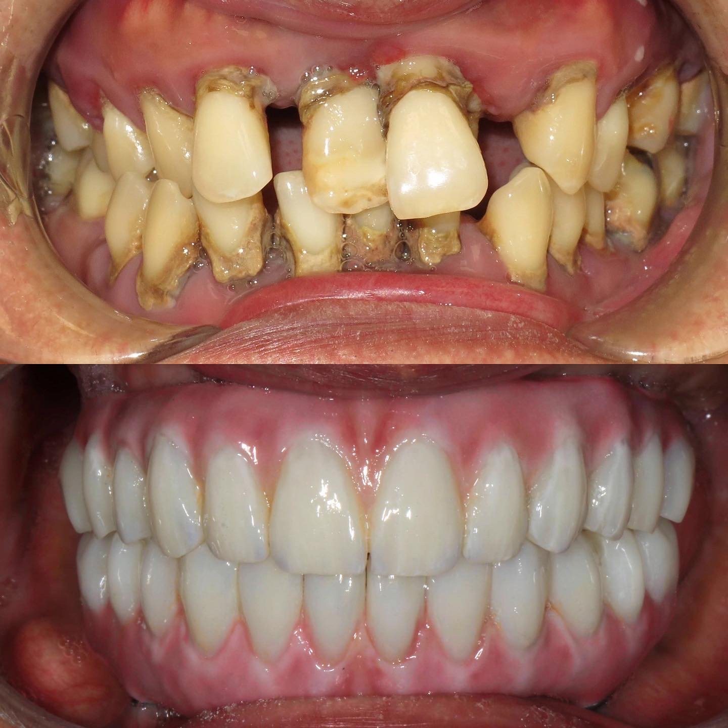 Dental Implant Cases case 221 — before