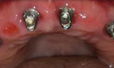 Dental Implant Cases case 23 — before