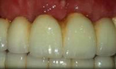 Dental Implant Cases case 23 — after