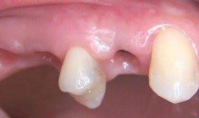 Dental Implant Cases case 24 — before