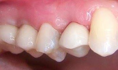 Dental Implant Cases case 24 — after