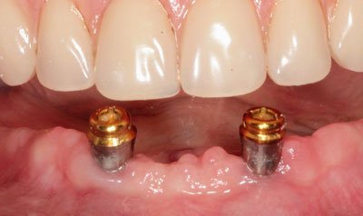 Dental Implant Cases case 49 — before