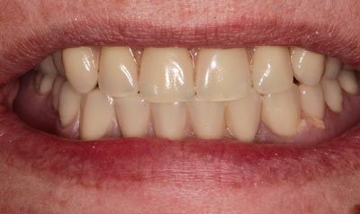 Dental Implant Cases case 49 — after