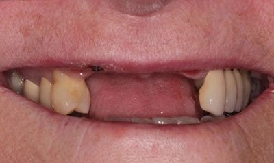 Dental Implant Cases case 56 — before