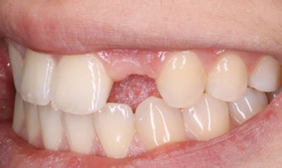 Dental Implant Cases case 80 — before