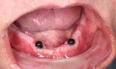 Dental Implant Cases case 83 — before