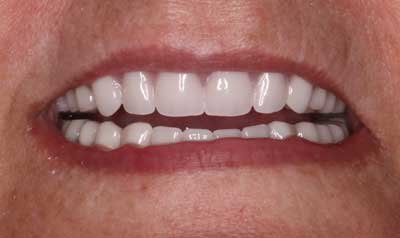 Dental Implant Cases case 83 — after