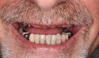 Dental Implant Cases case 90 — before