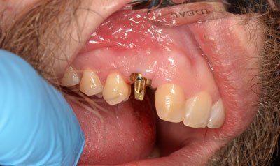 Dental Implant Cases case 2 — before