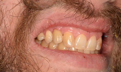 Dental Implant Cases case 2 — after