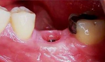 Dental Implant Cases case 6 — before