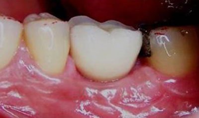 Dental Implant Cases case 6 — after