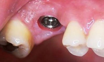 Dental Implant Cases case 9 — before