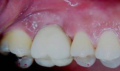 Dental Implant Cases case 9 — after