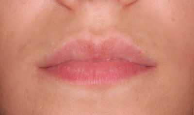 Dermal Lip Filler (Juvederm) case 63 — before