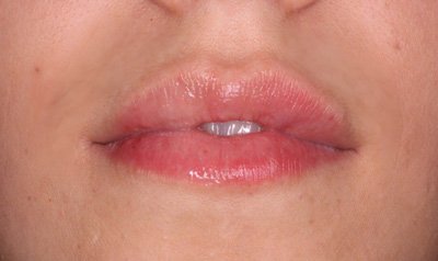 Dermal Lip Filler (Juvederm) case 63 — after